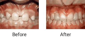 Crowding of the teeth