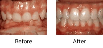 deep overbite lower front teeth vite into plate