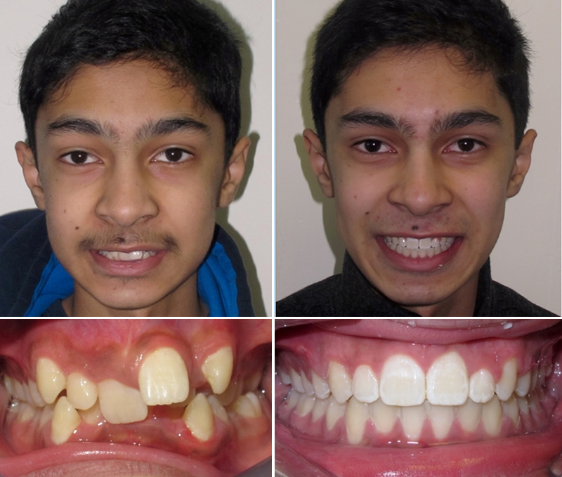 Boy with before after image