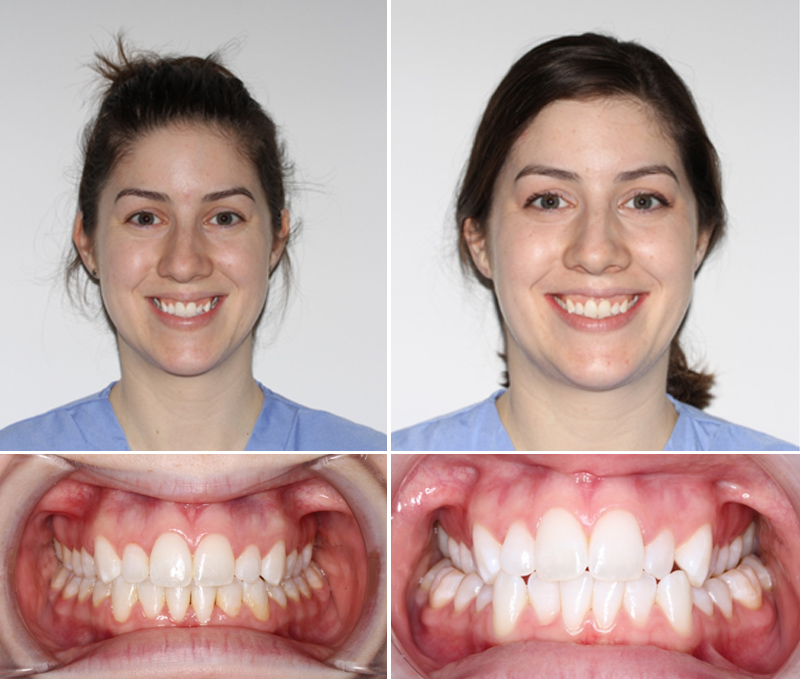 Women with before and after treatment