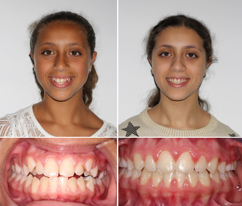 Women with before and after treatment