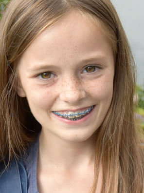 Life With Braces