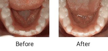 non braces treatment