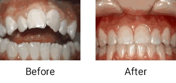 Open bite: front teeth don’t touch