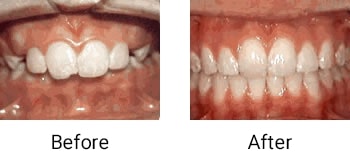 overjet protruding front teeth