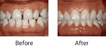 spacing of teeth