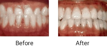 Underbite: lower front teeth in front of upper teeth