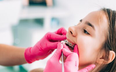 What Happens If You Have Braces and Do Not Brush Your Teeth?