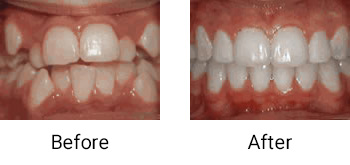 crowding of the teeth