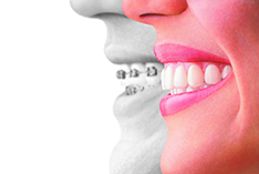 invisalign near you