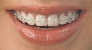 radiance clear braces in innisfil