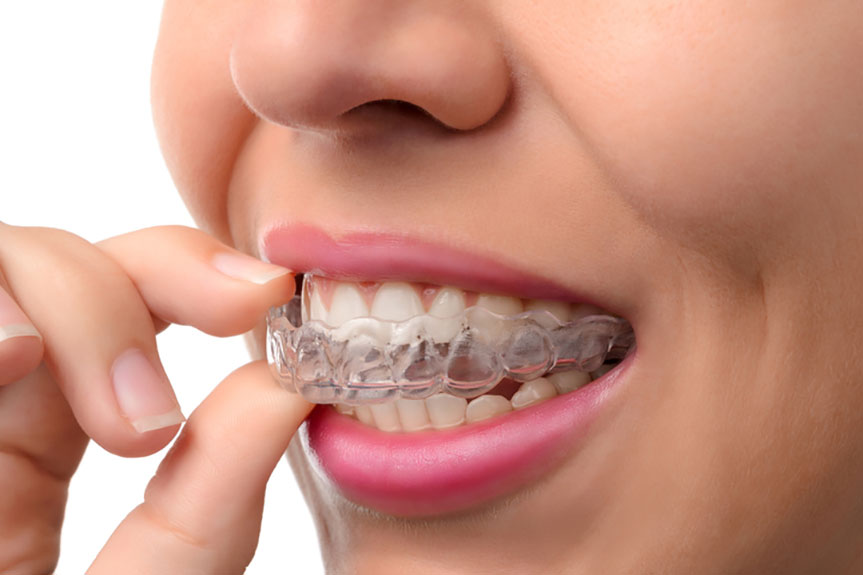 invisalign the best option for adults