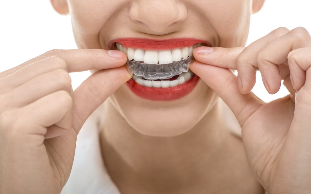 why invisalign is trending in two zero two one