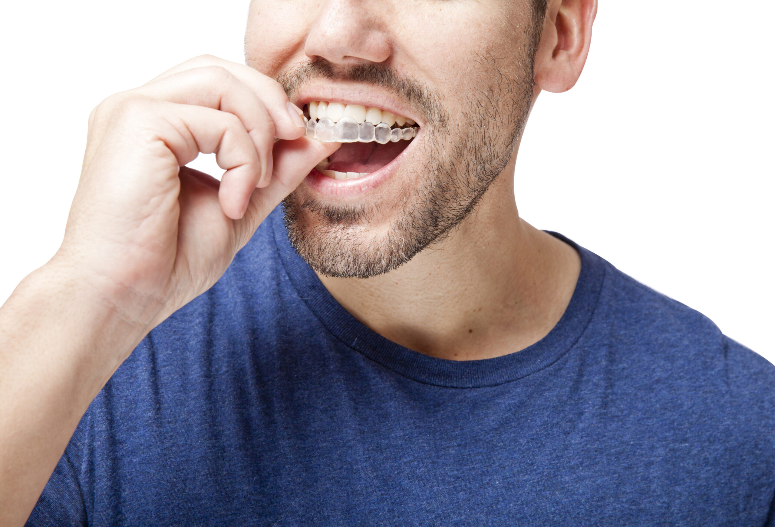Four Things You Shouldn't Do to Achieve a Successful Invisalign